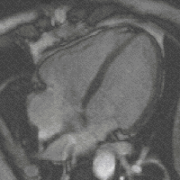 Herz 4 Kammern CD DVD Patient